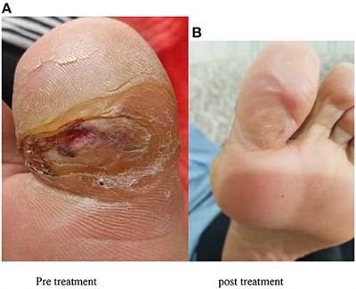 Evaluation of the effect of a gel made with amniotic fluid formulation on the healing of diabetic foot ulcers: A triple-blind clinical trial